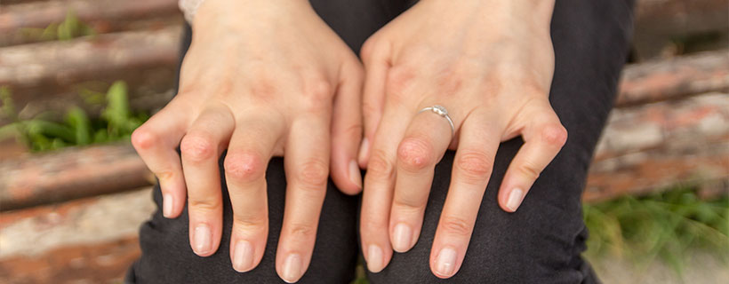 patient needing rheumatoid arthritis chiropractor in Corte Madera